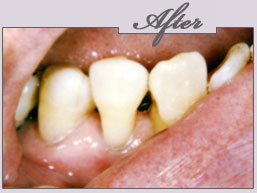 new york porcelain veneers