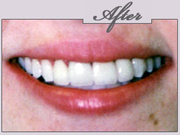 new york porcelain veneers