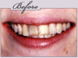 teeth whitening new york