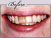 new york teeth whitening