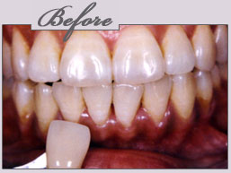 new york porcelain veneers