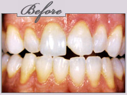 new york porcelain veneers