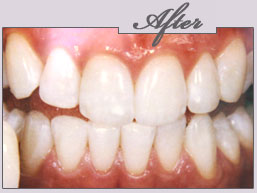 zoom whitening new york