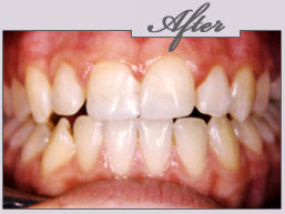 new york porcelain veneers