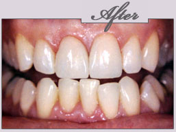 new york porcelain veneers