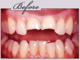 porcelain veneers new york