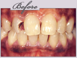 new york porcelain veneers