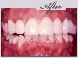 new york teeth whitening