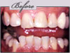 new york porcelain veneers