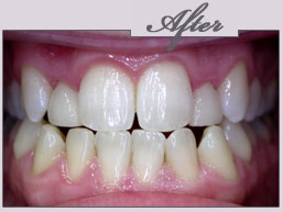 teeth whitening new york