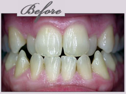 zoom whitening new york