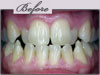 new york porcelain veneers