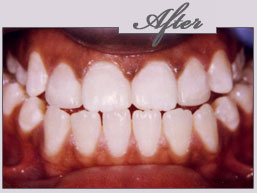 new york porcelain veneers