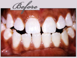 new york porcelain veneers