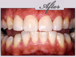 new york porcelain veneers