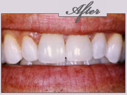 teeth whitening new york