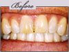 new york porcelain veneers