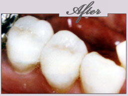 new york porcelain veneers