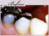  new york porcelain veneers